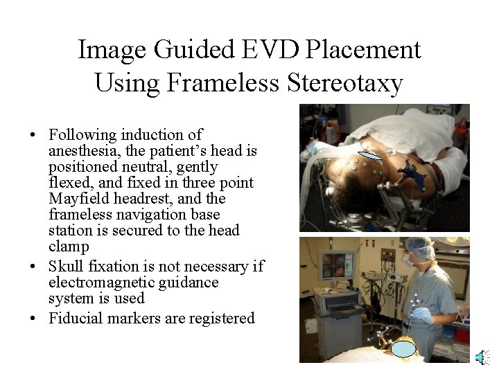 Image Guided EVD Placement Using Frameless Stereotaxy • Following induction of anesthesia, the patient’s