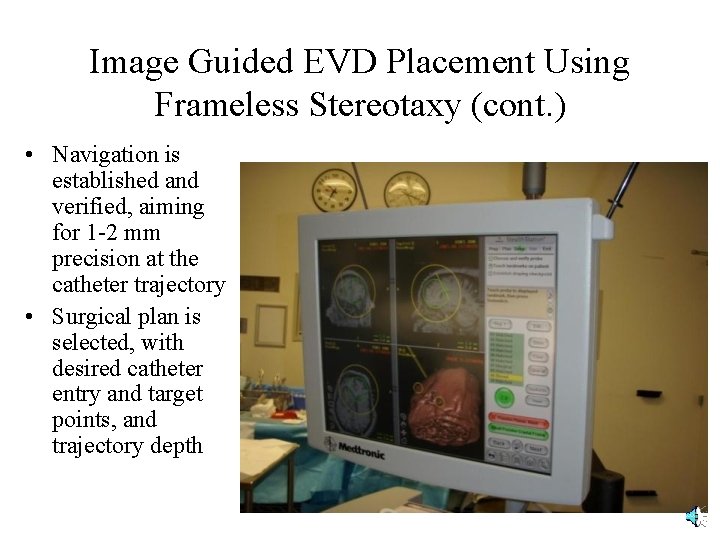 Image Guided EVD Placement Using Frameless Stereotaxy (cont. ) • Navigation is established and