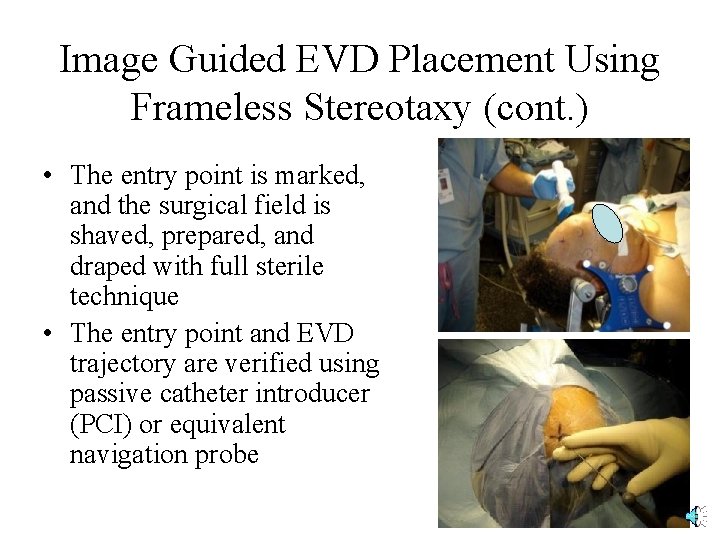 Image Guided EVD Placement Using Frameless Stereotaxy (cont. ) • The entry point is