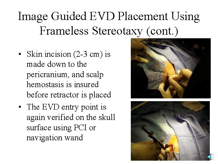 Image Guided EVD Placement Using Frameless Stereotaxy (cont. ) • Skin incision (2 -3