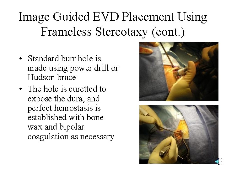 Image Guided EVD Placement Using Frameless Stereotaxy (cont. ) • Standard burr hole is