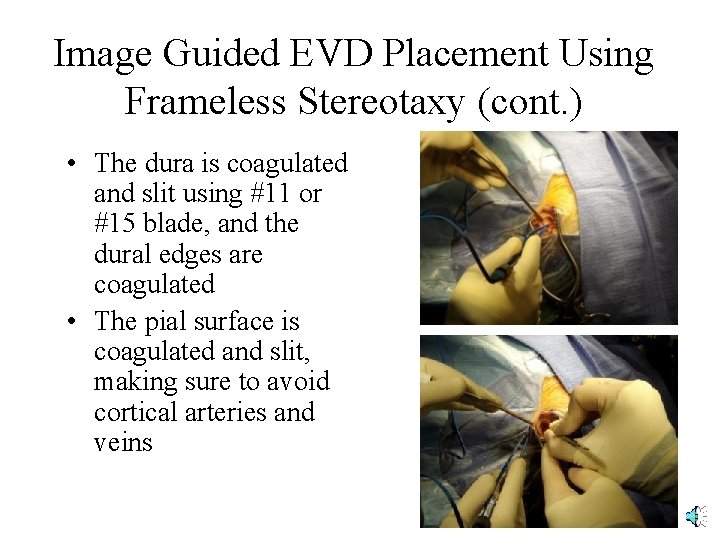 Image Guided EVD Placement Using Frameless Stereotaxy (cont. ) • The dura is coagulated