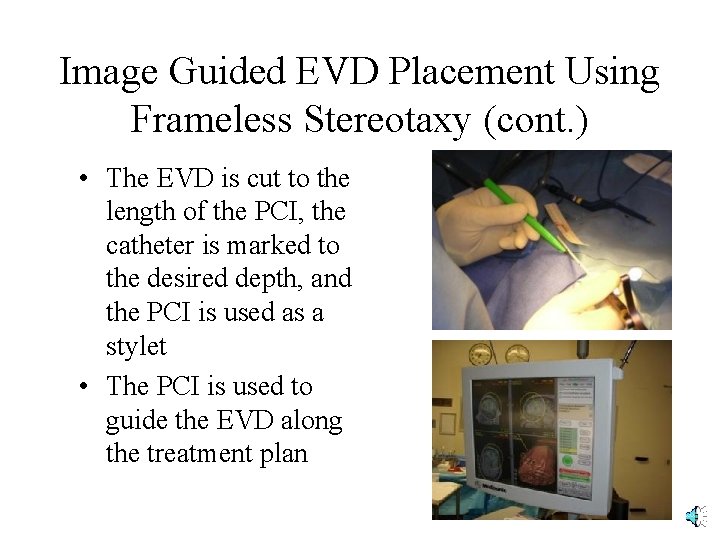 Image Guided EVD Placement Using Frameless Stereotaxy (cont. ) • The EVD is cut