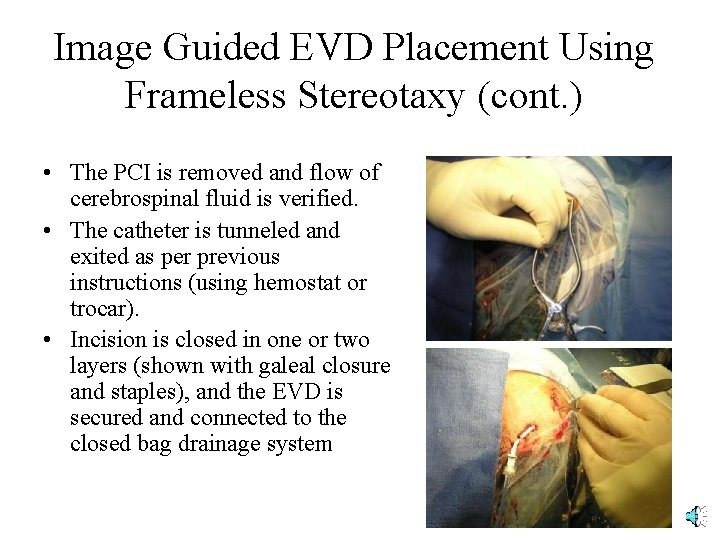 Image Guided EVD Placement Using Frameless Stereotaxy (cont. ) • The PCI is removed