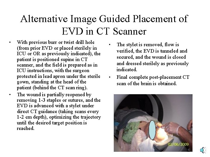 Alternative Image Guided Placement of EVD in CT Scanner • • With previous burr