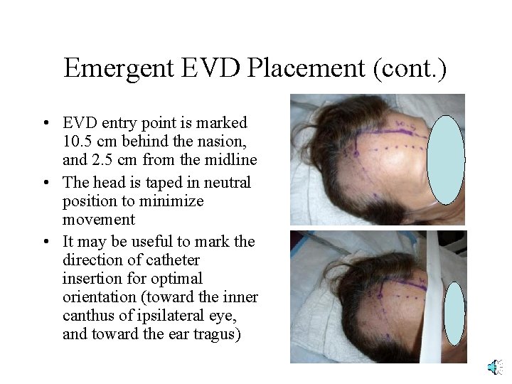 Emergent EVD Placement (cont. ) • EVD entry point is marked 10. 5 cm