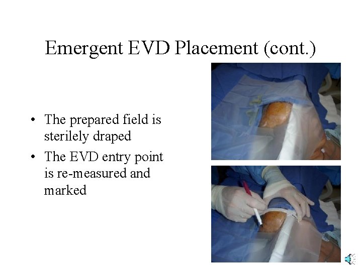 Emergent EVD Placement (cont. ) • The prepared field is sterilely draped • The