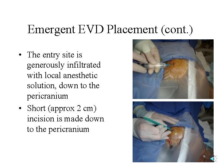 Emergent EVD Placement (cont. ) • The entry site is generously infiltrated with local