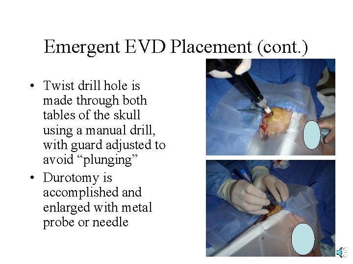 Emergent EVD Placement (cont. ) • Twist drill hole is made through both tables