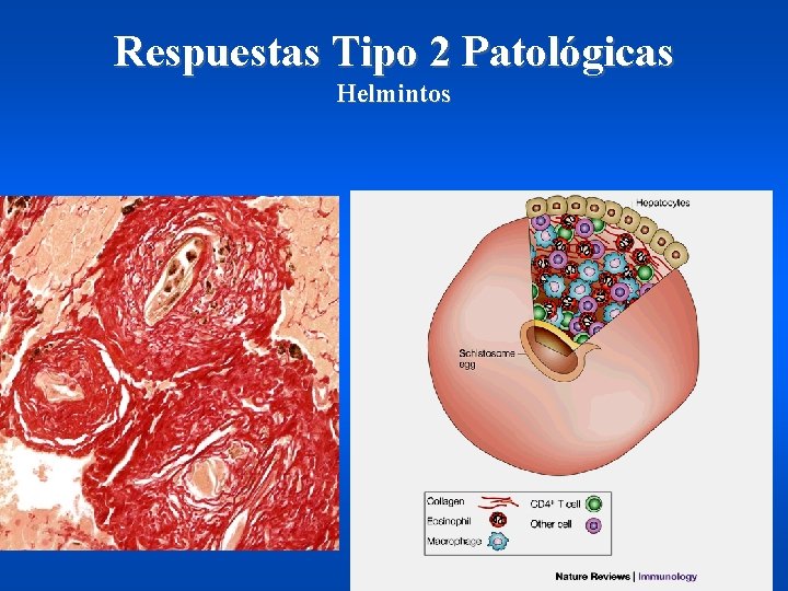 Respuestas Tipo 2 Patológicas Helmintos 