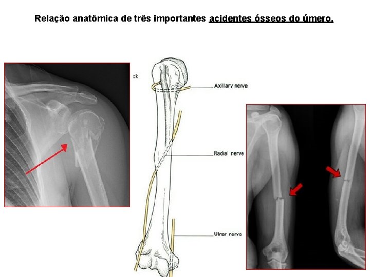 Relação anatômica de três importantes acidentes ósseos do úmero. 