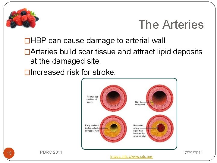The Arteries �HBP can cause damage to arterial wall. �Arteries build scar tissue and
