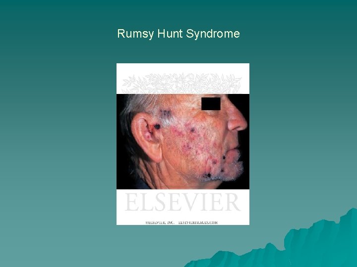 Rumsy Hunt Syndrome 