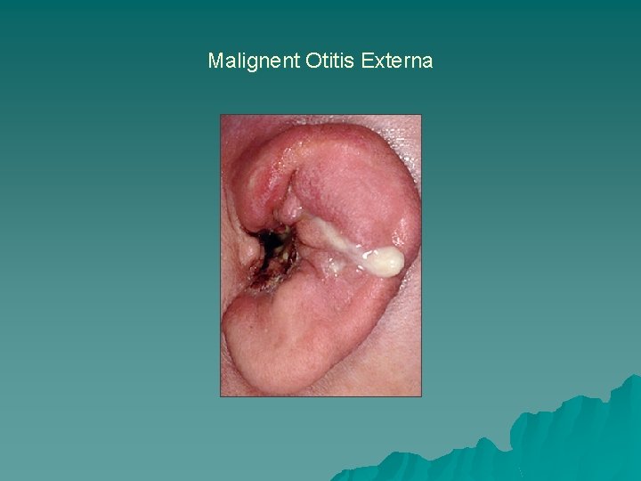Malignent Otitis Externa 