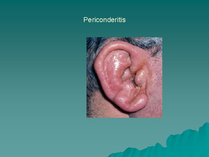 Periconderitis 