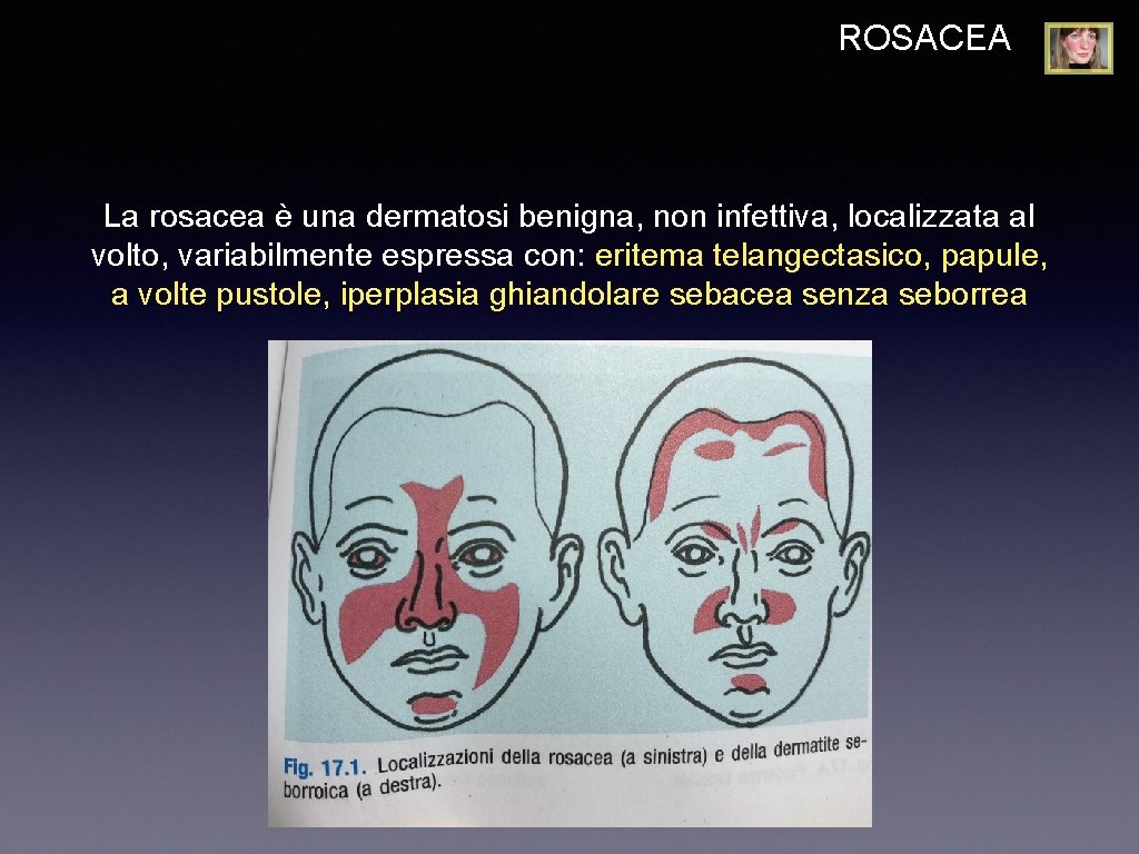 ROSACEA La rosacea è una dermatosi benigna, non infettiva, localizzata al volto, variabilmente espressa