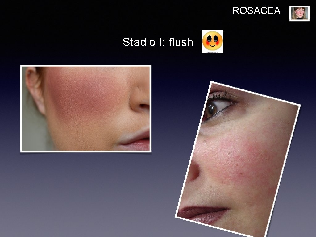 ROSACEA Stadio I: flush 