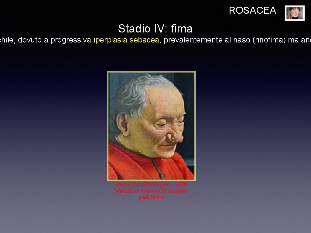 ROSACEA Stadio IV: fima chile, dovuto a progressiva iperplasia sebacea, prevalentemente al naso (rinofima)