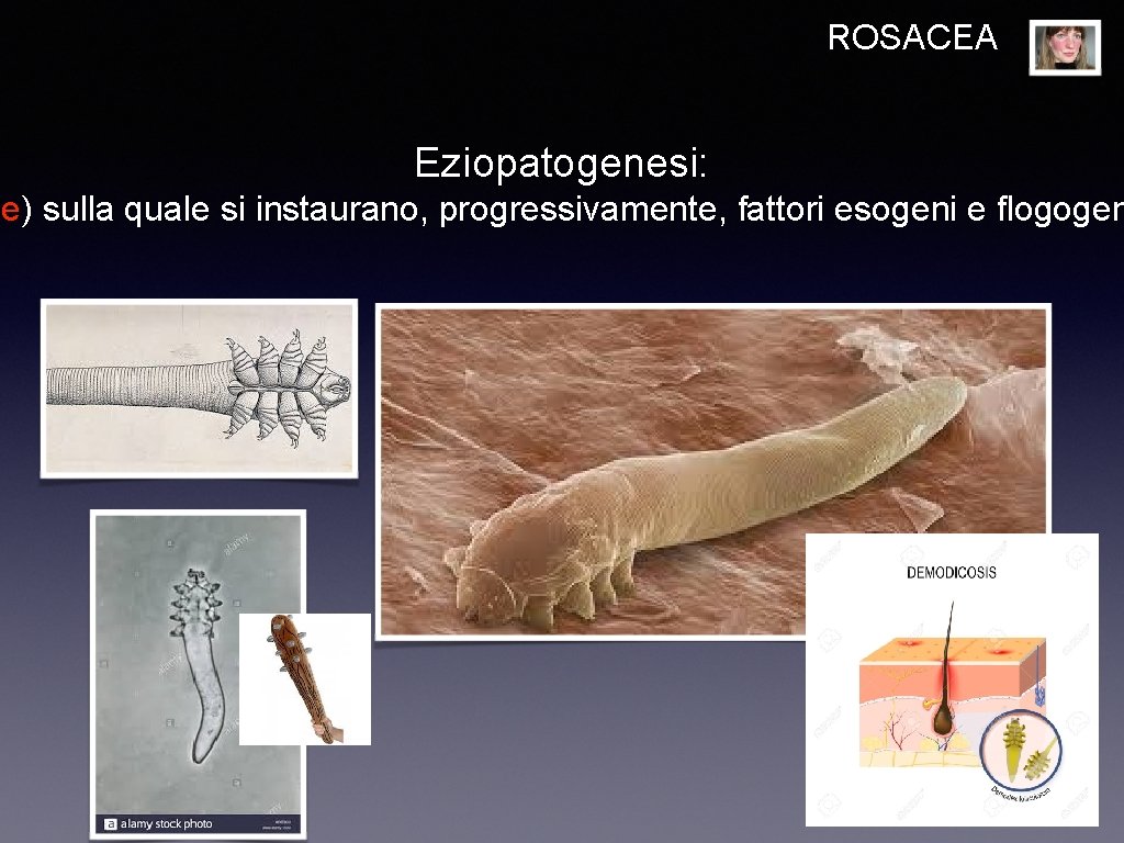 ROSACEA Eziopatogenesi: ne) sulla quale si instaurano, progressivamente, fattori esogeni e flogogen 