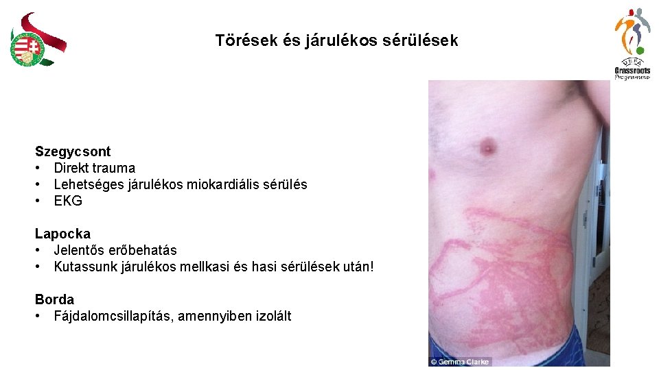 Törések és járulékos sérülések Szegycsont • Direkt trauma • Lehetséges járulékos miokardiális sérülés • Törések és járulékos sérülések Szegycsont • Direkt trauma • Lehetséges járulékos miokardiális sérülés •