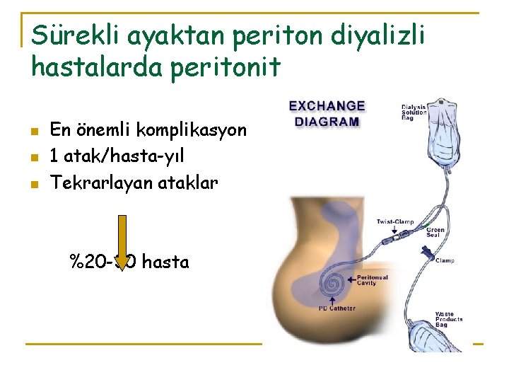 Sürekli ayaktan periton diyalizli hastalarda peritonit n n n En önemli komplikasyon 1 atak/hasta-yıl