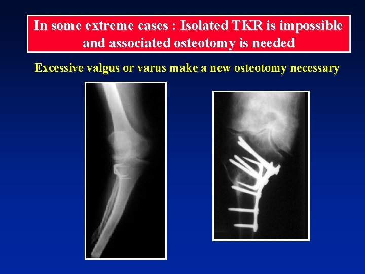 In some extreme cases : Isolated TKR is impossible and associated osteotomy is needed