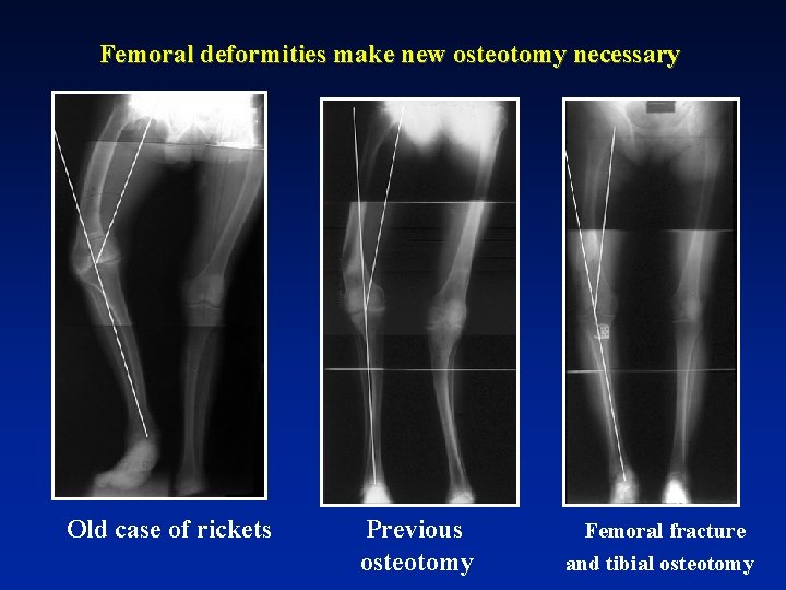 Femoral deformities make new osteotomy necessary Old case of rickets Previous osteotomy Femoral fracture