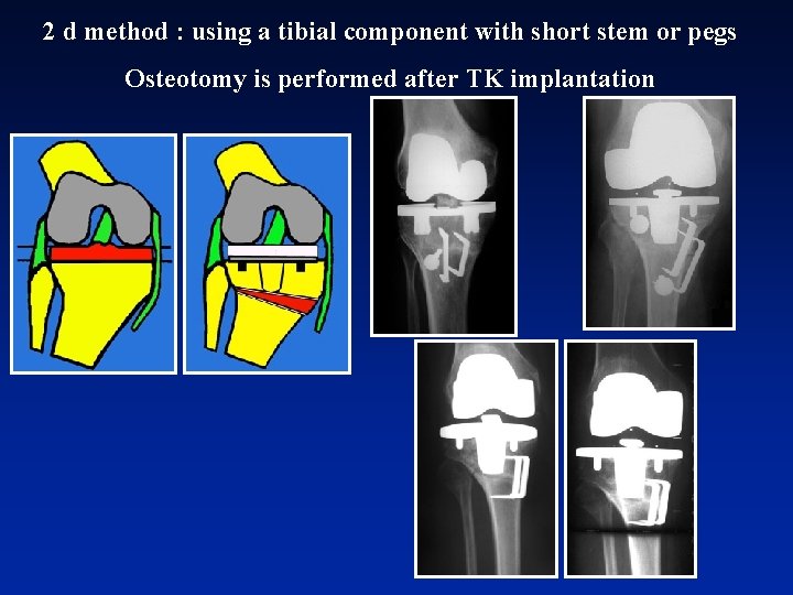 2 d method : using a tibial component with short stem or pegs Osteotomy