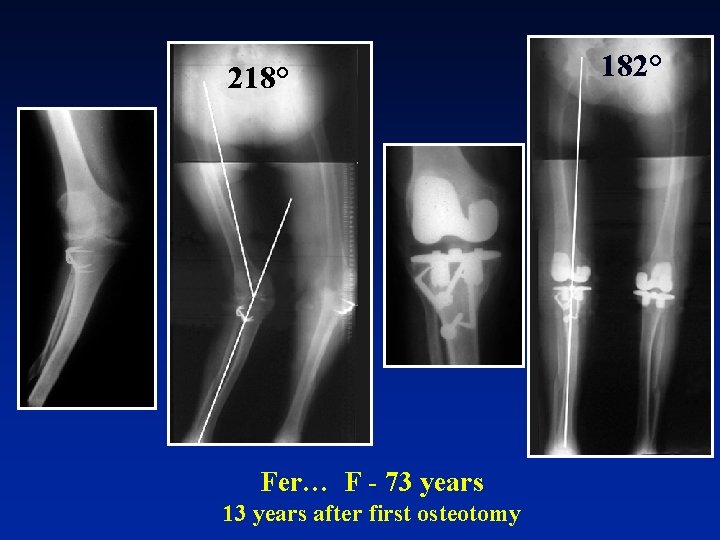 218° Fer… F - 73 years 13 years after first osteotomy 182° 