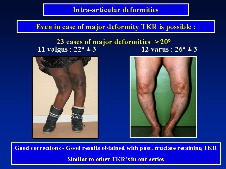 Intra-articular deformities Even in case of major deformity TKR is possible : 23 cases