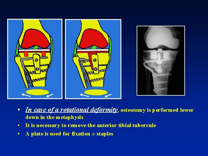  • In case of a rotational deformity, osteotomy is performed lower down in