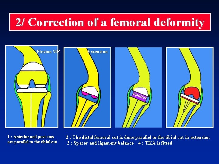 2/ Correction of a femoral deformity Flexion 90° 1 : Anterior and post cuts