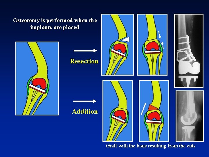 Osteotomy is performed when the implants are placed Resection Addition Graft with the bone