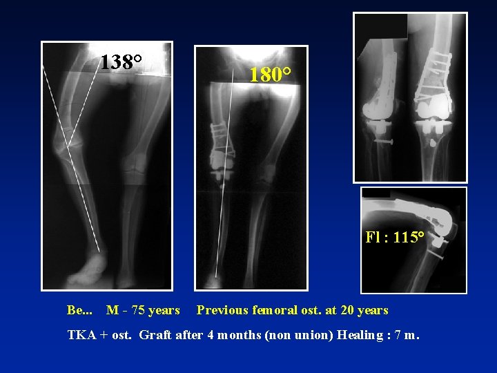 138° 180° Fl : 115° Be. . . M - 75 years Previous femoral