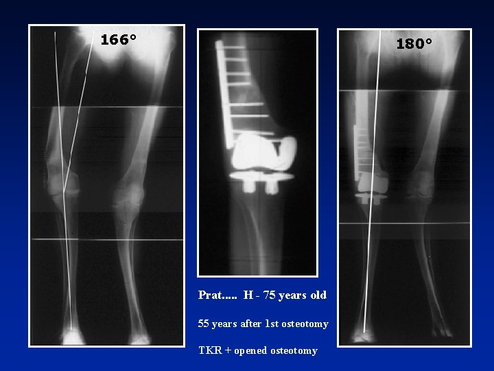 166° 180° Prat. . . H - 75 years old 55 years after 1