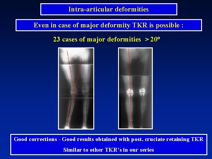 Intra-articular deformities Even in case of major deformity TKR is possible : 23 cases