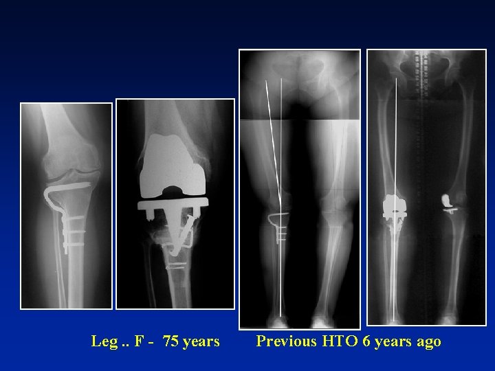 Leg. . F - 75 years Previous HTO 6 years ago 