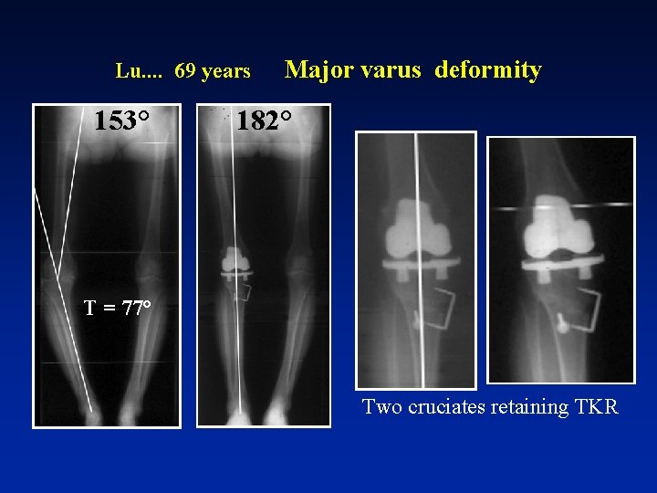 Lu. . 69 years 153° Major varus deformity 182° T = 77° Two cruciates