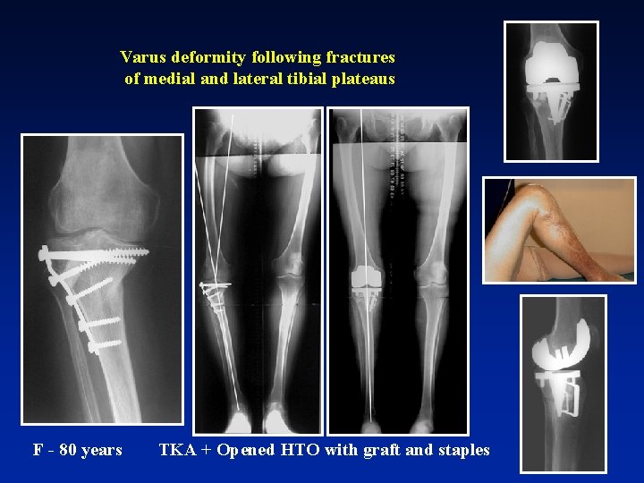 Varus deformity following fractures of medial and lateral tibial plateaus F - 80 years