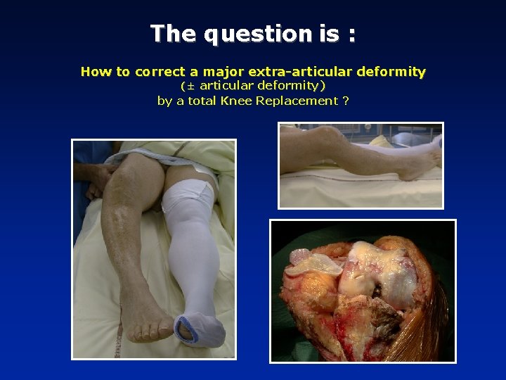 The question is : How to correct a major extra-articular deformity (± articular deformity)