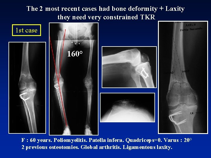 The 2 most recent cases had bone deformity + Laxity they need very constrained
