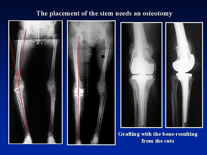 The placement of the stem needs an osteotomy Grafting with the bone resulting from