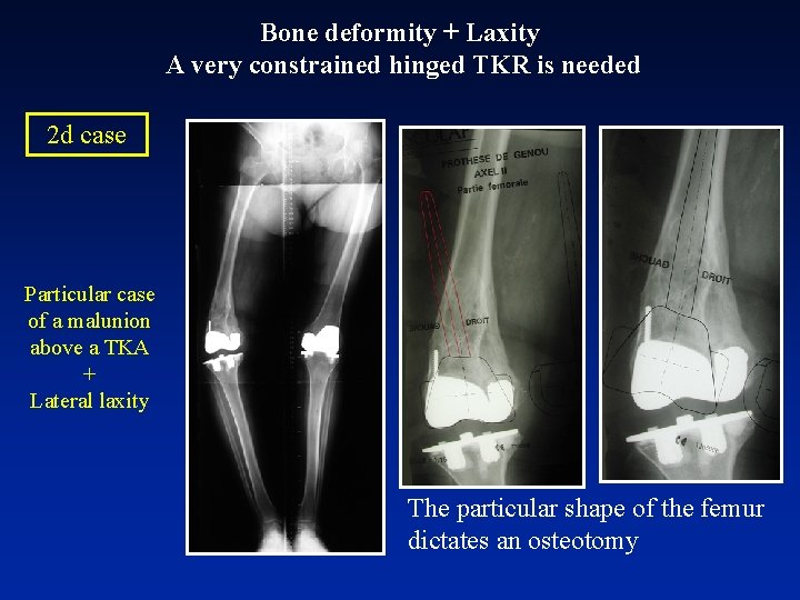 Bone deformity + Laxity A very constrained hinged TKR is needed 2 d case