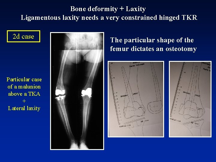 Bone deformity + Laxity Ligamentous laxity needs a very constrained hinged TKR 2 d