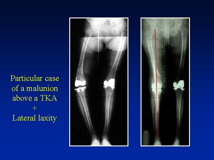 Particular case of a malunion above a TKA + Lateral laxity 