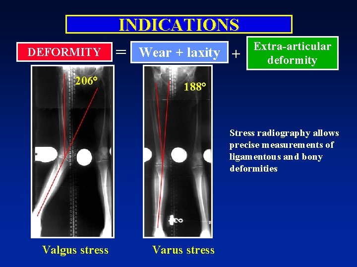 DEFORMITY 206° INDICATIONS = Wear + laxity + Extra-articular deformity 188° Stress radiography allows