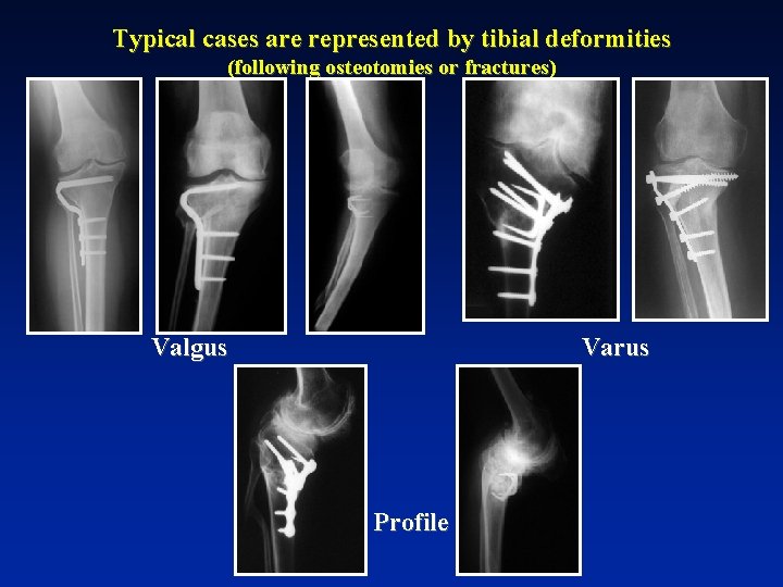 Typical cases are represented by tibial deformities (following osteotomies or fractures) Valgus Varus Profile