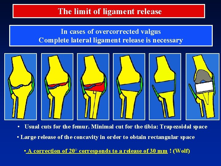 The limit of ligament release In cases of overcorrected valgus Complete lateral ligament release