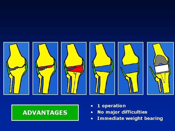 ADVANTAGES • 1 operation • No major difficulties • Immediate weight bearing 