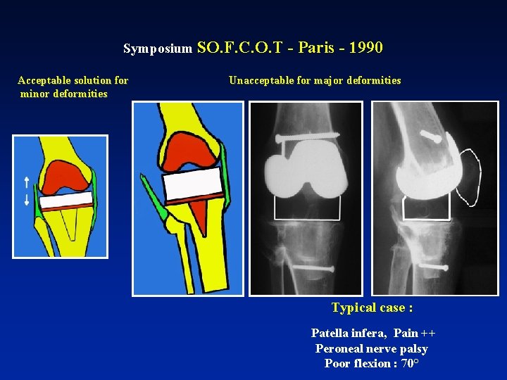 Symposium SO. F. C. O. T Acceptable solution for minor deformities - Paris -